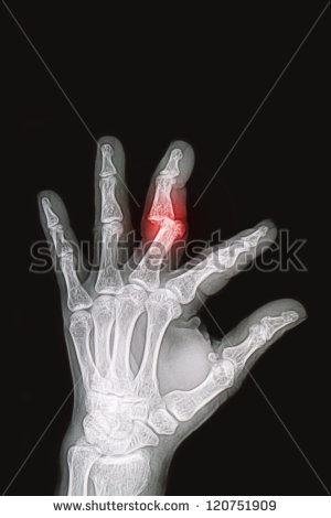     Fracture And Dislocation Bone Stock Photo 120751909   Shutterstock