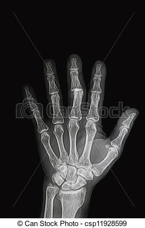 Photo   Wrist And Hand X Rays Image Show Fracture And Dislocation Bone    