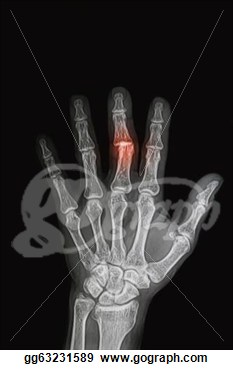     Rays Image Show Fracture And Dislocation Bone  Stock Photos Gg63231589