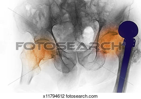 Showing Hip Arthritis And Dislocation Of Hip View Large Photo Image