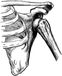 Subcoracoid Dislocation Of The Humerus