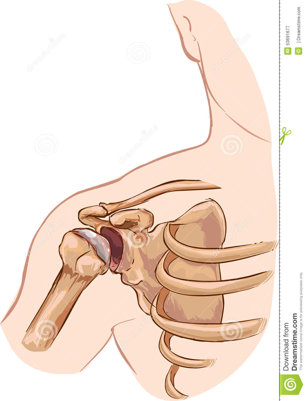 Vector Illustration Of Shoulder Dislocation