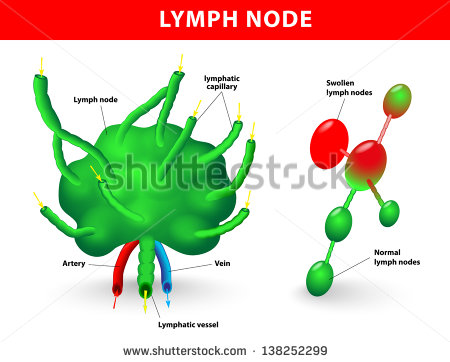 Showing The Flow Of Lymph  Swollen Lymph Nodes And Normal Lymph Nodes