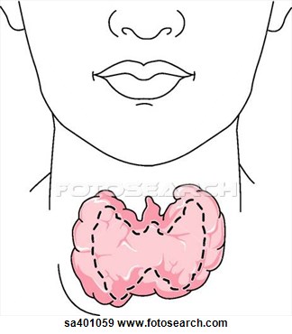 Illustration Of An Enlarged Thyroid  Sa401059   Search Vector Clipart