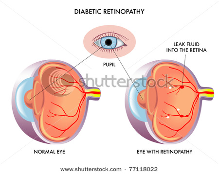 Diabetic Retinopathy   Clipart Illustration Picture