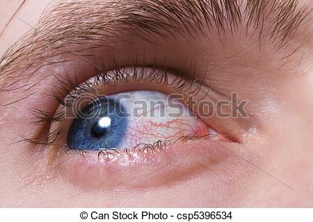 Stock Photo   Blue Men Eye With Red Blood Vessels   Stock Image