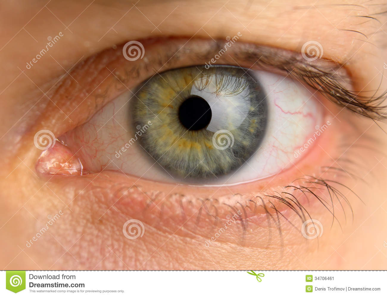 Tired Man Eye With Blood Vessels Stock Image   Image  34706461