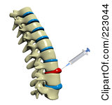 Spinal Back Pain 3d Female Skeleton With Highlighted Spinal Cord