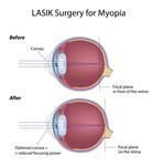 Illustration Of A Laser Eye Correction Laser Eye Surgery Diagram