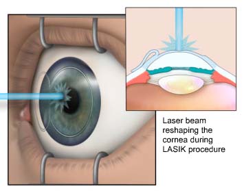 Laser Eye Surgery And Denial