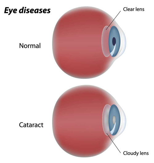 Laser Surgery  Laser Surgery For Eyes Eye Floaters After Cataract