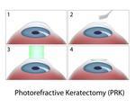     Prk Eye Surgery Conductive Keratoplasty Eye Surgery Nearvision
