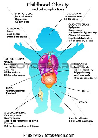 Clip Art Of Childhood Obesity K18919427   Search Clipart Illustration
