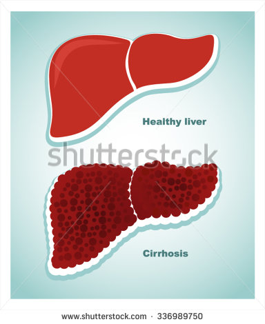 Healthy Liver And A Liver With Cirrhosis  Vector Illustration
