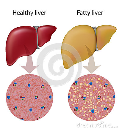 Liver Disease With Fat Accumulated In Liver Cells