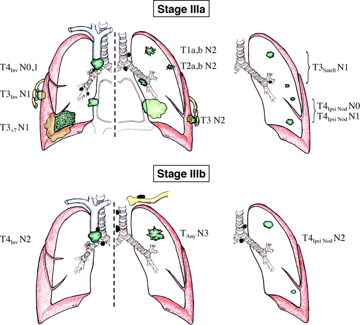Lung Cancer Symbols