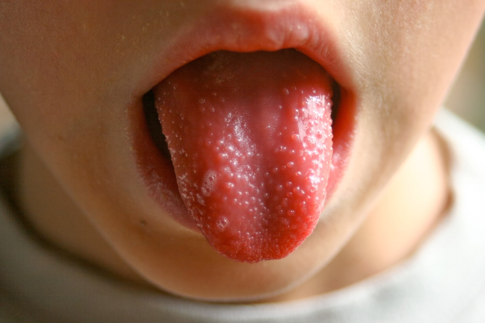 Rough Swollen Tongue Typical Of Scarlet Fever