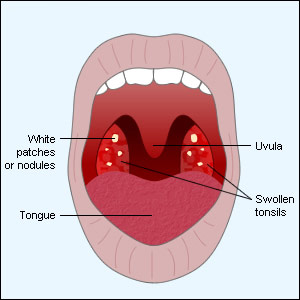 Facts On Tonsillitis Treatment   Are There Natural Cure For