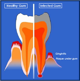 Gum Sores Around Tooth Swollen Gums Around Tooth Are