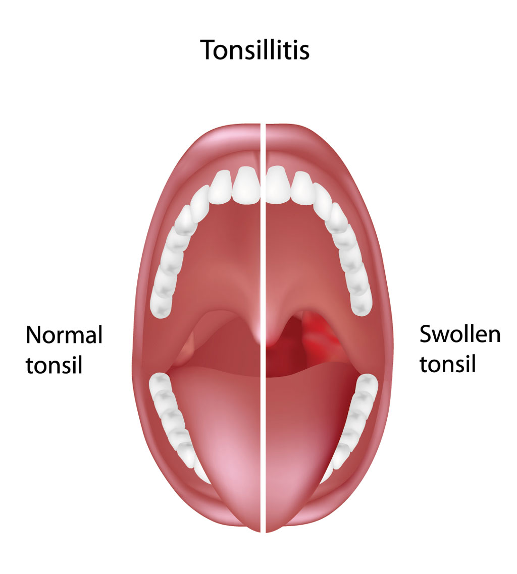 Tonsil Hypertrophy  Enlarged Tonsils    Otolaryngology Specialists Of