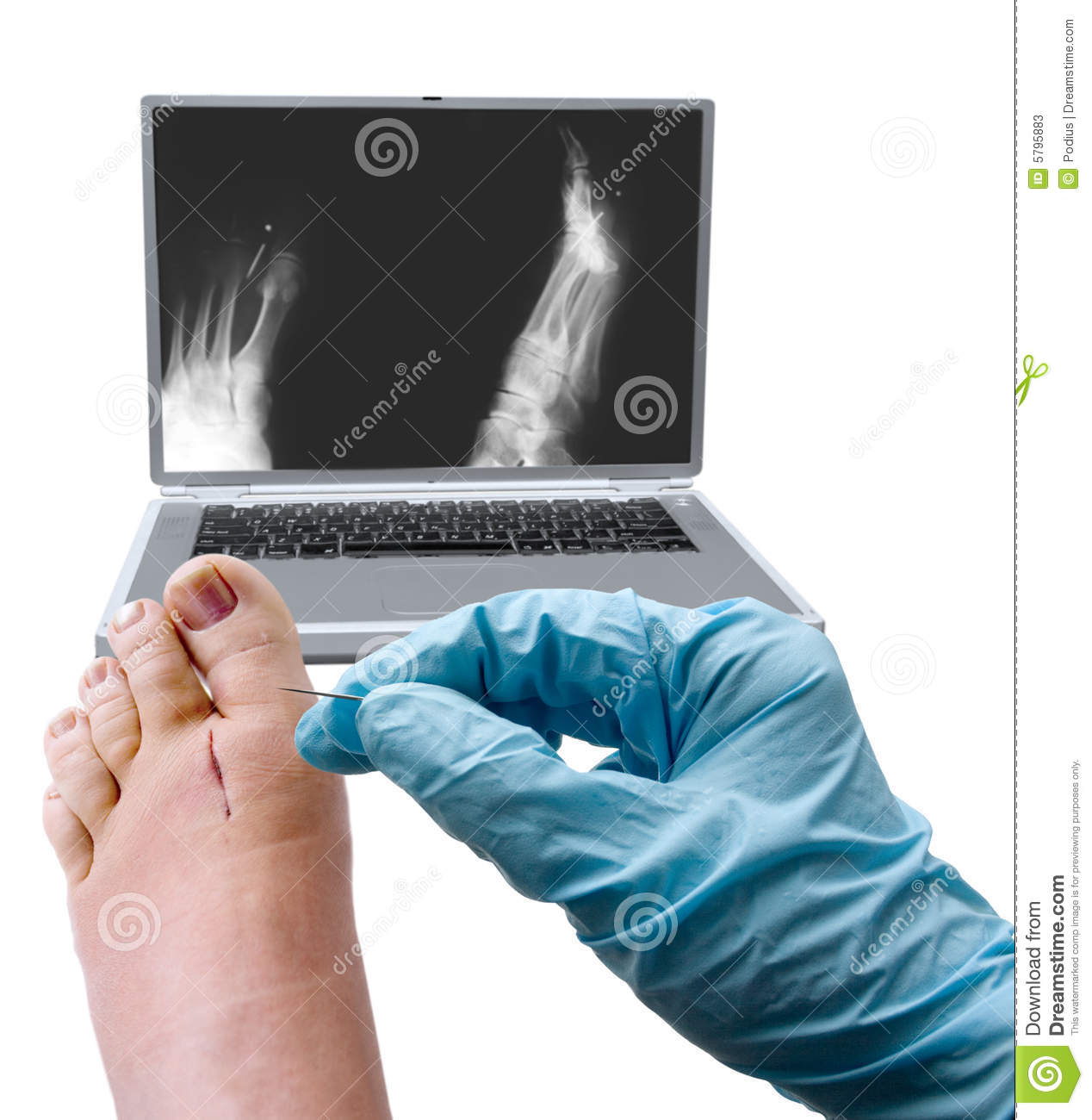 Foot Surgery Stock Photos   Image  5795883