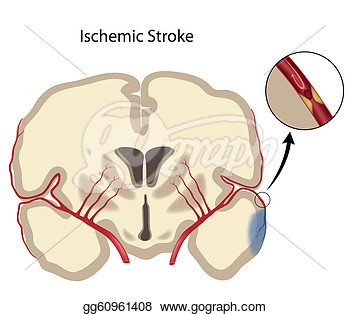 Showing Gallery For Stroke Patient Clipart