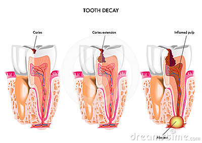 Tooth Decay Royalty Free Stock Photo   Image  24574035