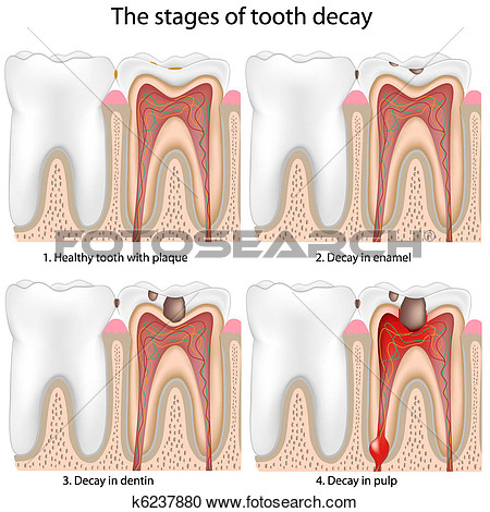Tooth Decay View Large Clip Art Graphic
