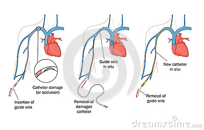 Catheter Cartoons Catheter Pictures Illustrations And Vector Stock