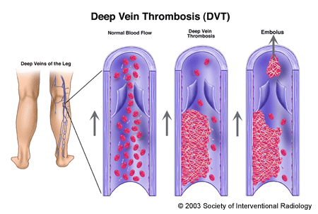 Deep Vein Thrombosis And Pulmonary Embolism Overview   Sir