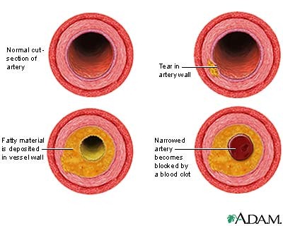 If Blood Vessels Sustain Damage The Body Uses Cholesterol As A    