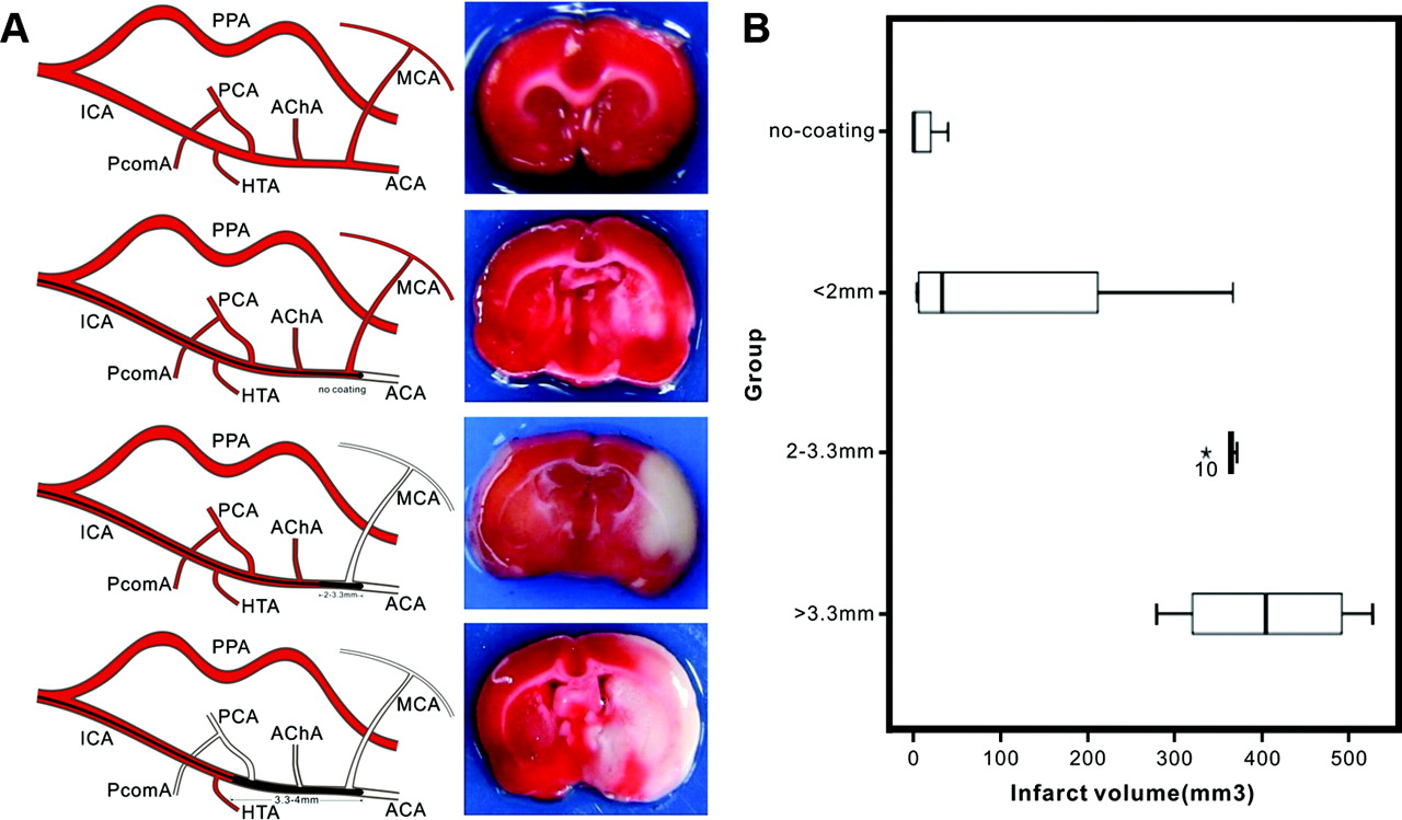 Effect Of Suture Properties On Stability Of Middle Cerebral Artery