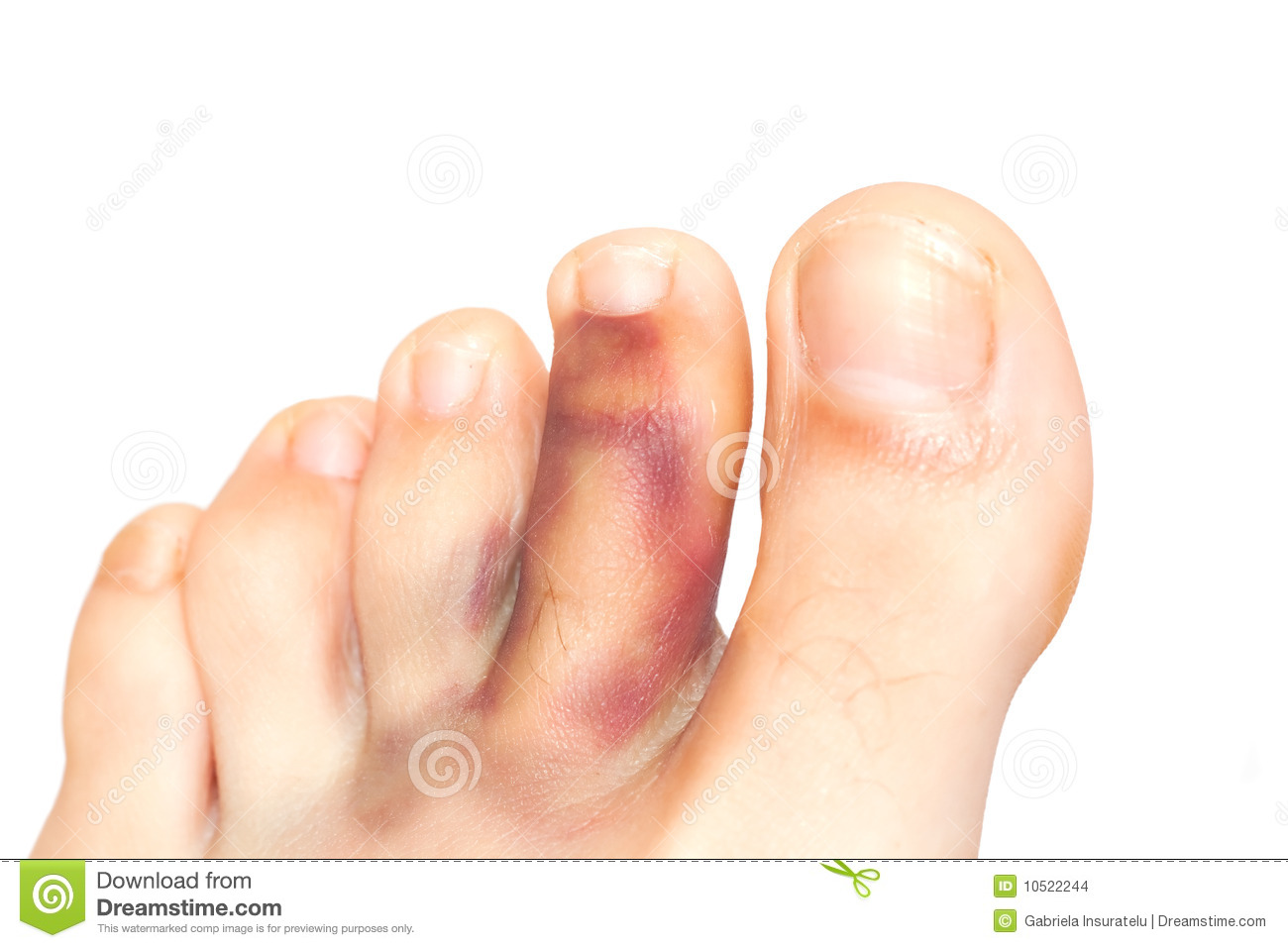 Broken Toe Stock Images   Image  10522244