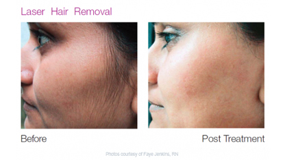 Laser Hair Removal Before And After Women Laser Hair Removal Before    