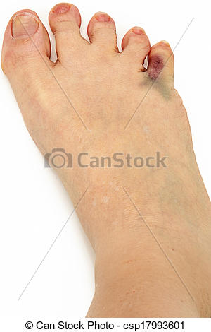 Stock Photo   Bruised Broken Toe   Stock Image Images Royalty Free    