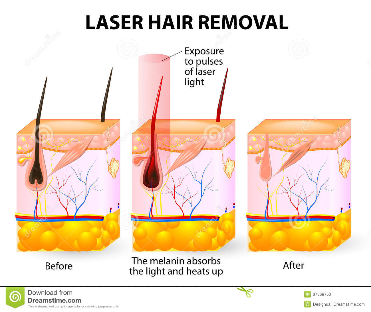 The Skin Without Damaging It  At The Hair Follicle The Laser    