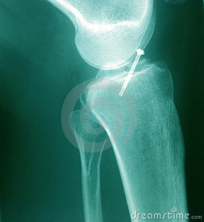 An X Ray Of A Broken Knee With A Bolt 