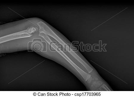 Broken Arm X Ray Clipart Broken Arm Xray   Csp17703965