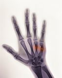 Hand X Ray Showing A Boxer S Fracture Stock Photo