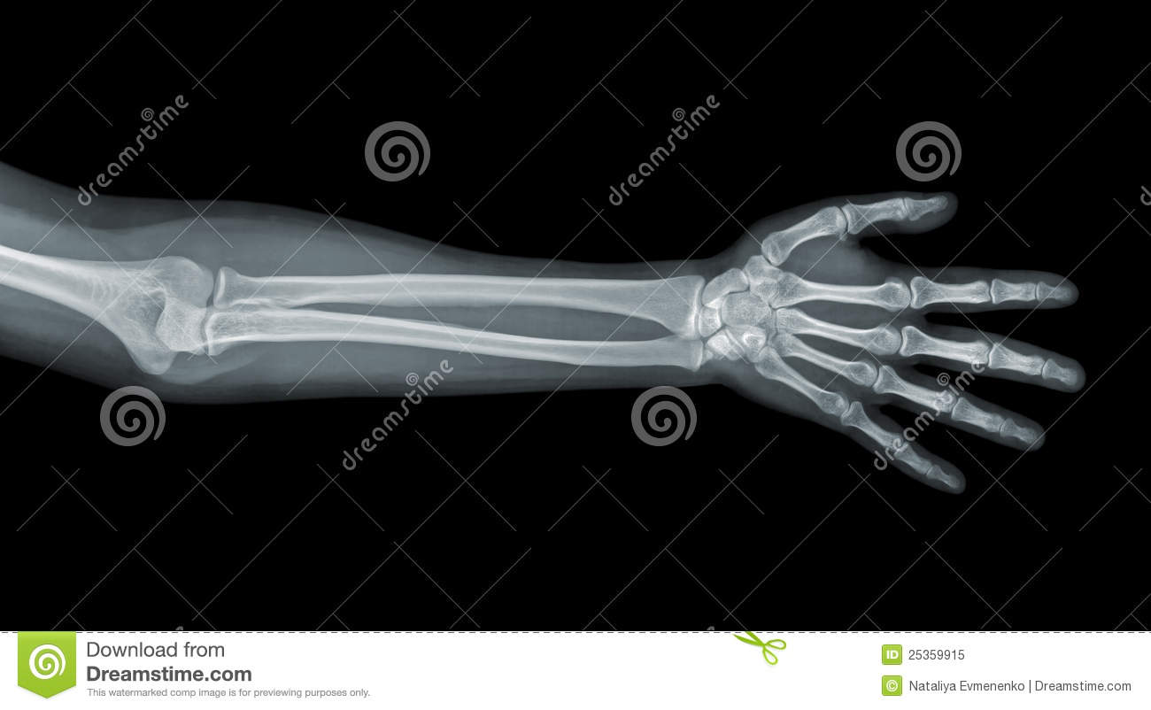 Hand X Ray View Royalty Free Stock Photo   Image  25359915