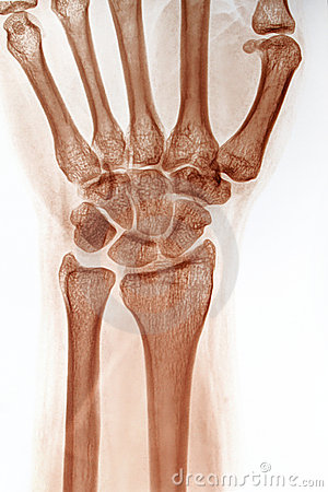 Neagtive Wrist X Ray Royalty Free Stock Photography   Image  7521627