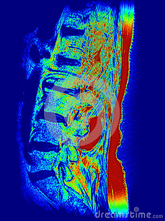 Colorful Rare Large Cystic Lesion In The Area Of Lumbar Spine On The