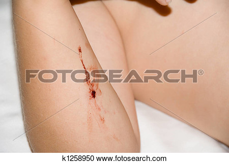 Stock Photography   Dog Bite Wound  Fotosearch   Search Stock Photos