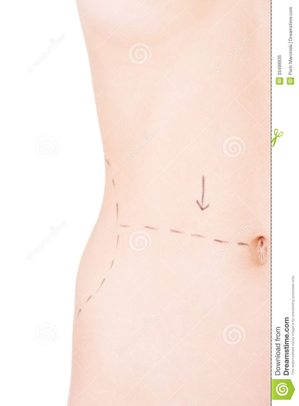 Woman Belly Marked Out For Cosmetic Surgery  Royalty Free Stock Photo