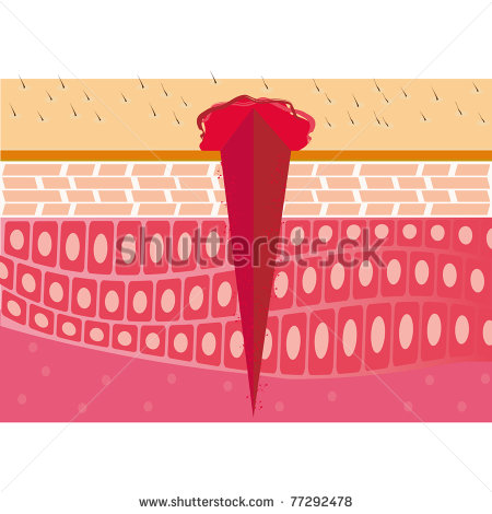 Wound Skin Cross Section Anatomy Medical Vector Illustration   Stock