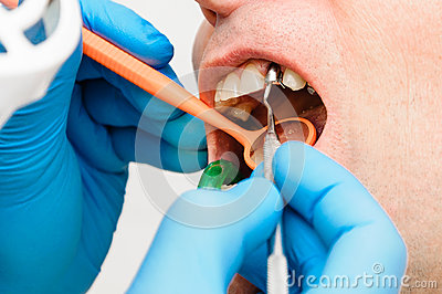     Teeth Of Male Person People Man Mouth  Broken Teeth Hospital Surgery
