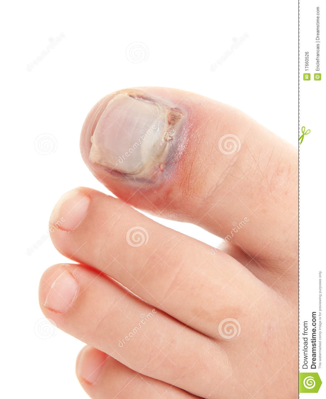 Broken Big Toe With Nail Detachment Royalty Free Stock Image   Image