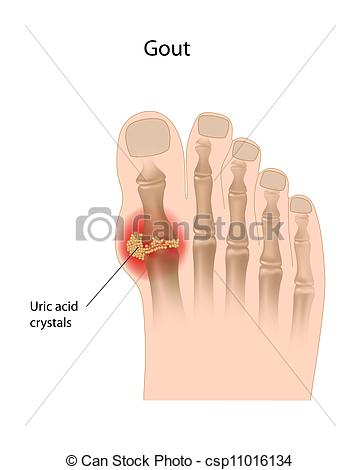 Vector   Gout Of The Big Toe Eps10   Stock Illustration Royalty Free