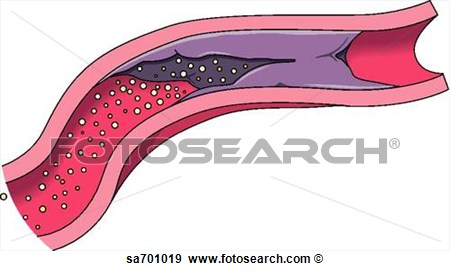 Of Blood Vessel Blocked By Clot   Fotosearch   Search Vector Clipart