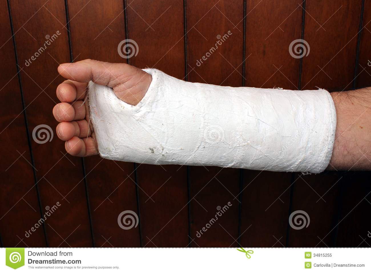 Arm In Plaster Royalty Free Stock Photo   Image  34815255